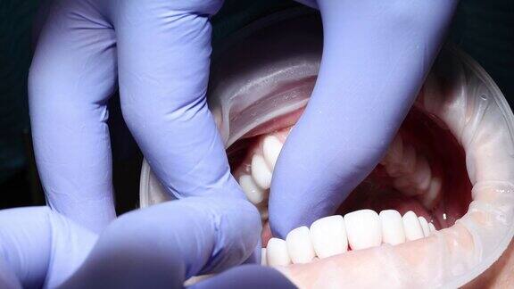 牙科在女性牙齿上安装白色贴面