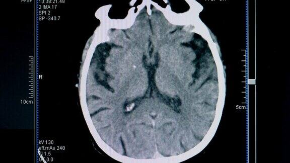 脑部扫描图像在显示器上逐渐消失
