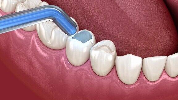 前磨牙复合充填修复医学精确牙齿3D动画