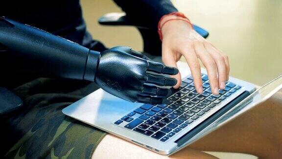 一名男子正用他天然的假肢在笔记本电脑的键盘上打字Cyborg