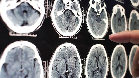 医生分析大脑x射线图像