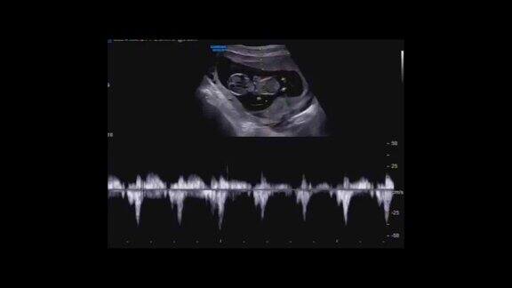 胎儿的超声图像