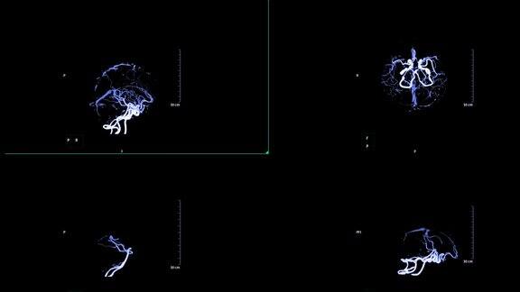 脑部CTA或脑部ct血管造影3DMIP显示大脑动脉