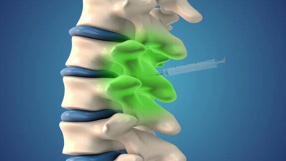 在动画中干细胞被注射到脊椎中