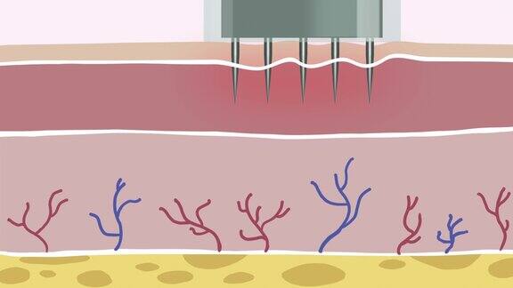 微针胶原蛋白诱导疗法4k平面动画