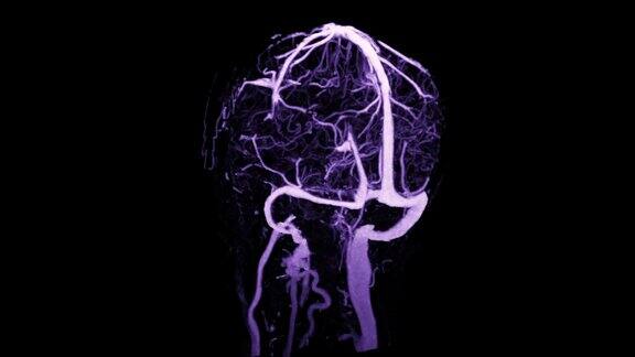 CTV脑扫描三维绘制诊断静脉窦血栓形成