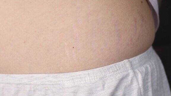 特写身体的妊娠纹和疤痕失去弹性女孩露出受损的皮肤