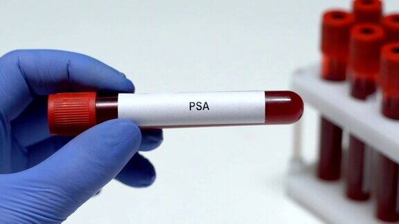 PSA实验室工作人员拿着血液样本在试管中近距离观察健康检查