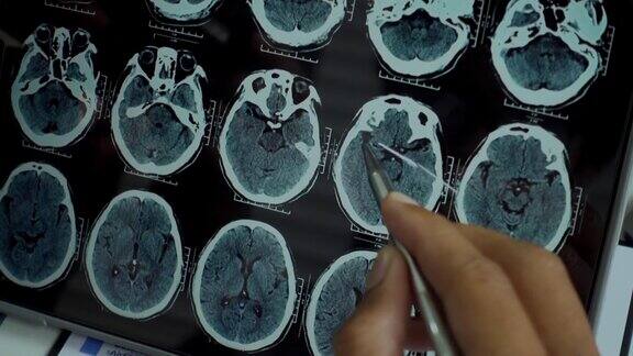 医生检查MRI脑部扫描