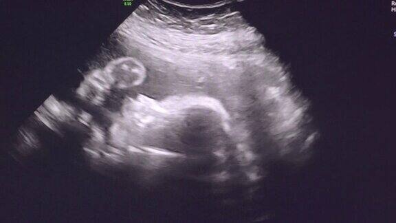 23周胎儿的超声波