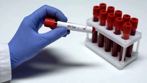 HIV检测呈阳性医生提供血样实验室研究健康检查