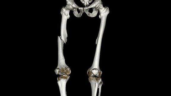 骨折股骨的ct扫描