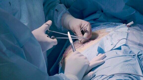 腹部手术腹部的外科手术缝合