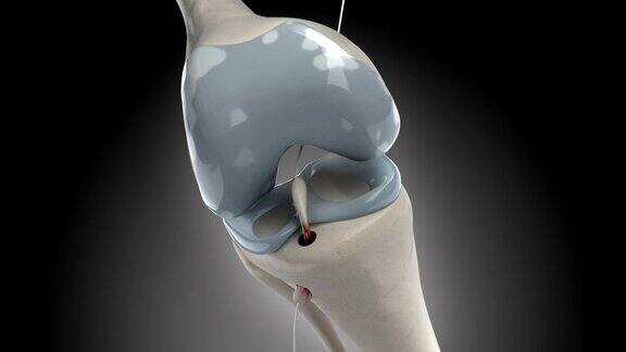 膝关节镜下十字韧带置换期