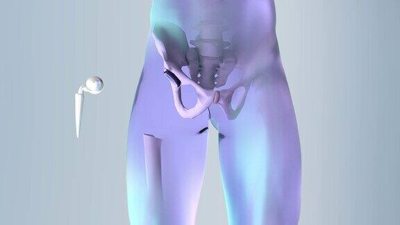 髋关节置换植入物安装在盆骨里的3D动画