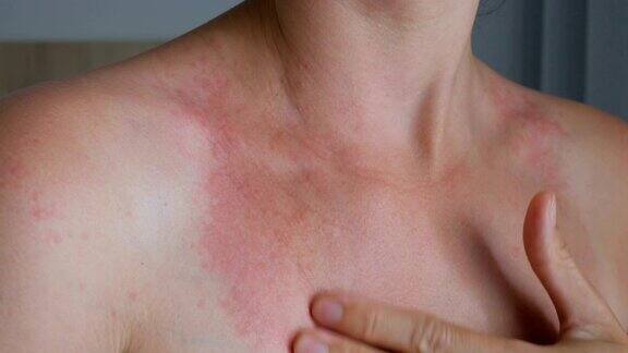 女人用手抓痒颈脖子上有红斑过敏牛皮癣虫咬疟疾晒伤晒伤