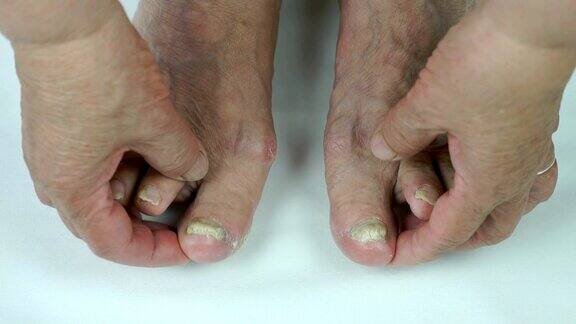 患有真菌感染的妇女的脚趾甲