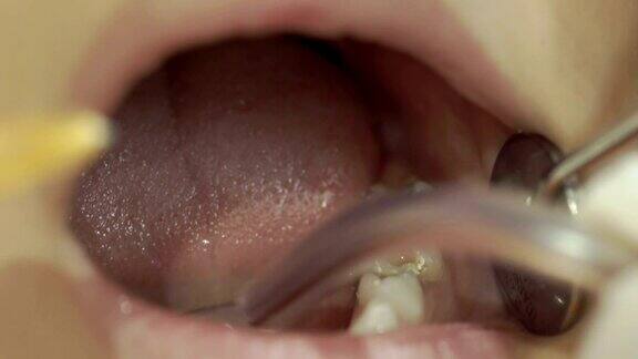 牙医将注射器注射到患者嘴里口腔卫生