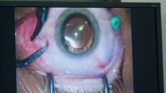 干预中的眼科手术工具