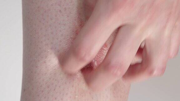 闭合:银屑病患者抓挠痒红色鳞屑和斑片状皮肤湿疹