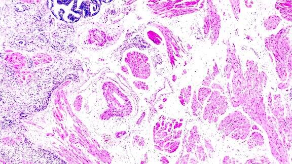 前列腺癌活检在显微镜放大下的不同区域