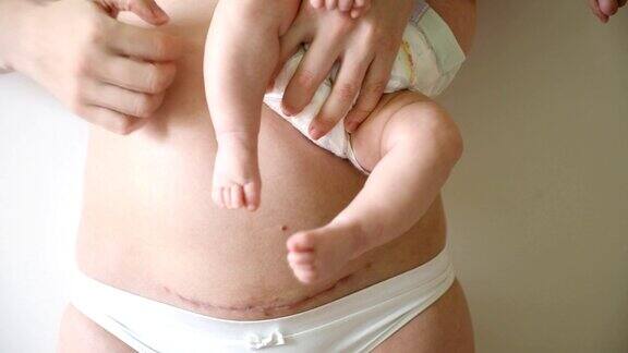 特写的妇女腹部疤痕从剖腹产手上抱着婴儿的女人