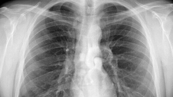 胸部x光片