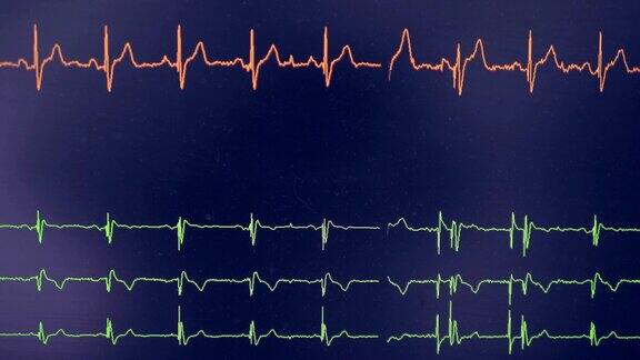 真正的心电图心电图示波器在屏幕上显示心跳率