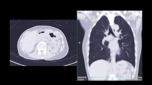 胸部或肺部CT扫描以诊断肺部疾病