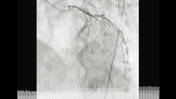 冠状动脉造影