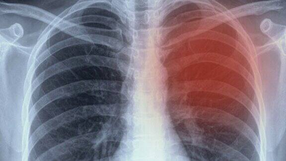 肺癌或肺气肿