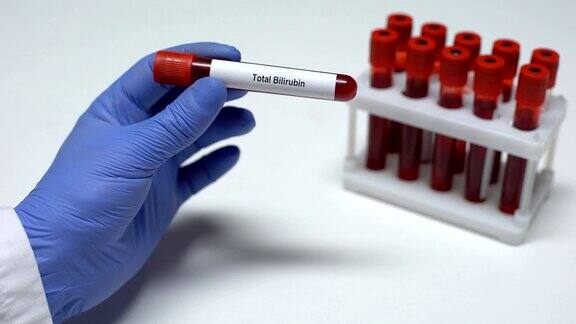 总胆红素医生在试管中出示血样实验室研究健康检查