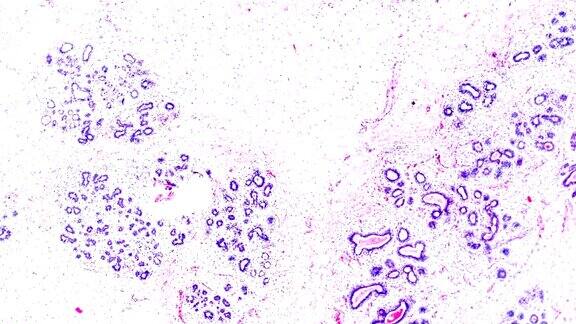 乳癌在光镜下的不同区域变焦