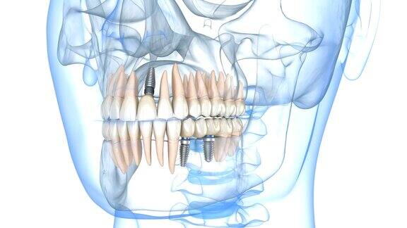 牙齿种植修复医学上精确的人类牙齿和假牙的三维动画概念