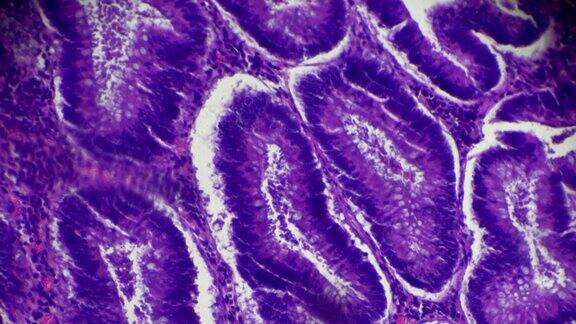 显微镜下的大肠癌(差异很大管状腺癌)