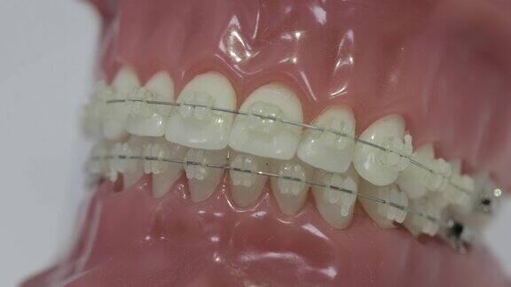 牙齿模型与牙套矫正突出颌骨在牙医