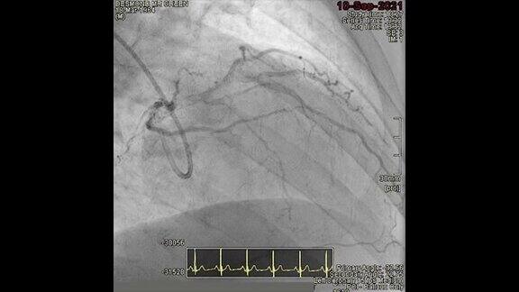 冠状动脉成形术支架置入术