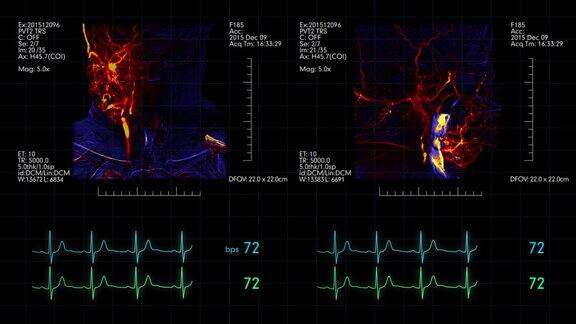 医疗显示器上面有两张脑血管造影