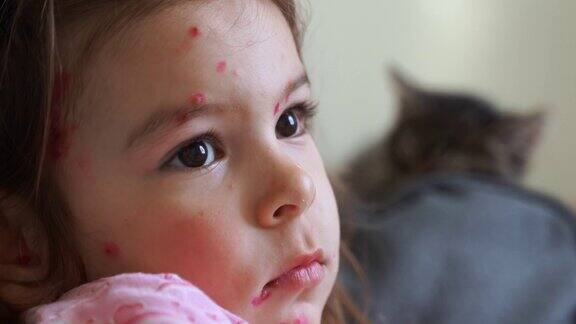 蹒跚学步的女孩身上有水痘麻疹水痘病毒儿童传染病有发痒、红水泡、发烧、疼痛的症状