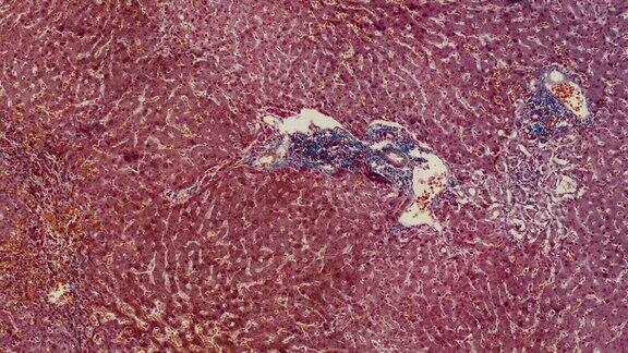 显微镜下人类肝硬化的动画有肿块和肿胀