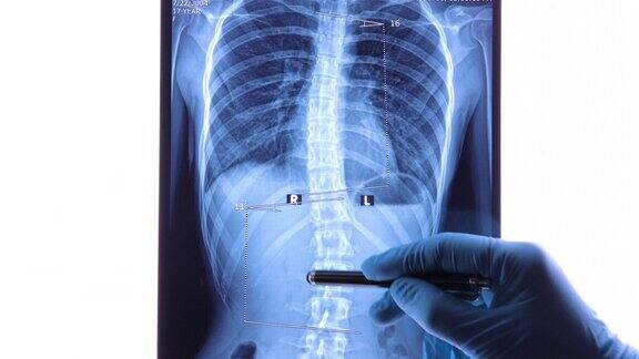 医生分析脊柱X线片显示腰椎侧弯