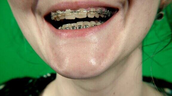 括号戴牙套的女孩微笑着绿色rir