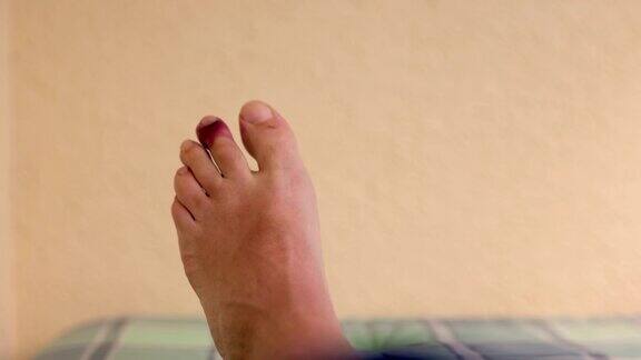 脚趾受伤的POV有青紫淤青