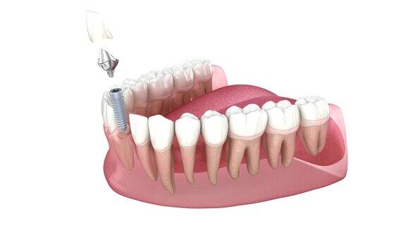 烤瓷冠定制种植基台及牙科种植医学3D动画