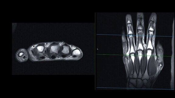 手部磁共振成像或磁共振成像