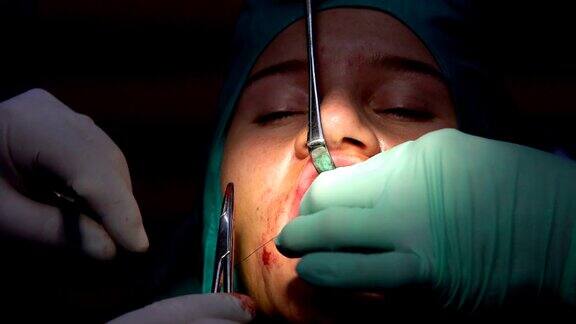 口腔外科手术cist根尖切除术暗室手术