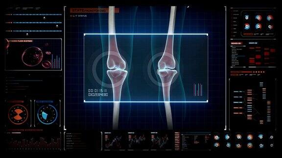 人类医疗中心膝关节关节炎疼痛数字显示健康关节和不健康伴有骨关节炎的疼痛关节4k