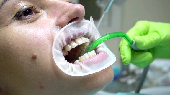 在牙科诊所里拿着扩张器的年轻女人用水清洁牙齿现代牙科诊所牙科医生使用唾液喷射器或牙科泵排出唾液在4k拍摄