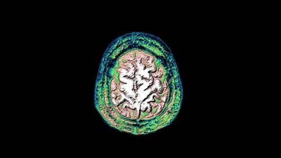 大量彩色MRI扫描大脑和头部来检测肿瘤医疗诊断工具