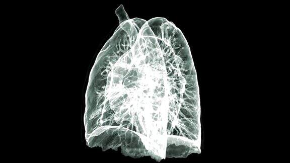 CT胸部3D渲染图像